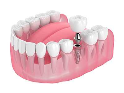 single-implant