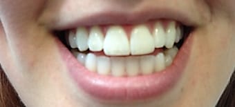Before and After Invisalign Treatment Kingston
