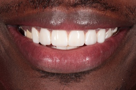 Before and After Invisalign Treatment Kingston