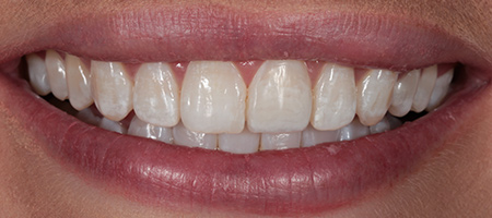 Before and After Bonding Treatment Kingston