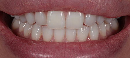 Before and After Bonding Treatment Kingston