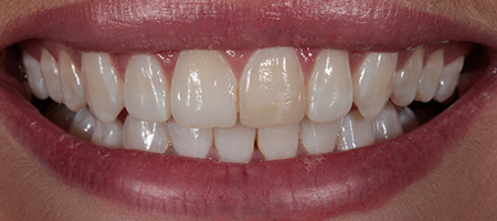 Before and After Bonding Treatment Kingston