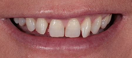 Before and After Bonding Treatment Kingston