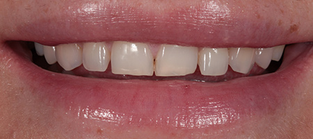 Before and After Bonding Treatment Kingston