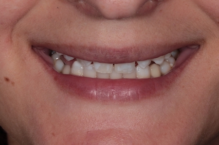 Before and After Bonding Treatment Kingston