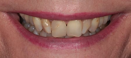 Before and After Bonding Treatment Kingston