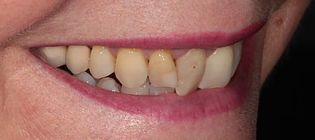Before and After Bonding Treatment Kingston