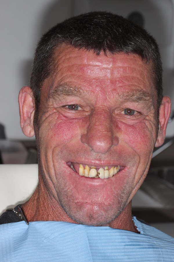 Before and After Implants Treatment  Kingston