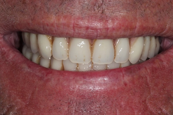Before and After Invisalign Treatment Kingston