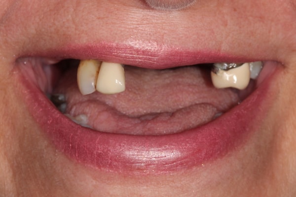 Before and After Invisalign Treatment Kingston