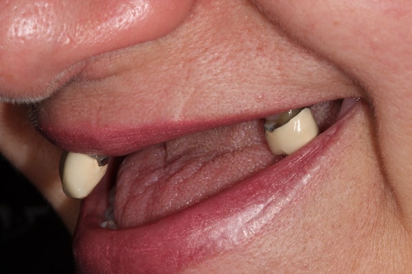 Before and After Invisalign Treatment Kingston