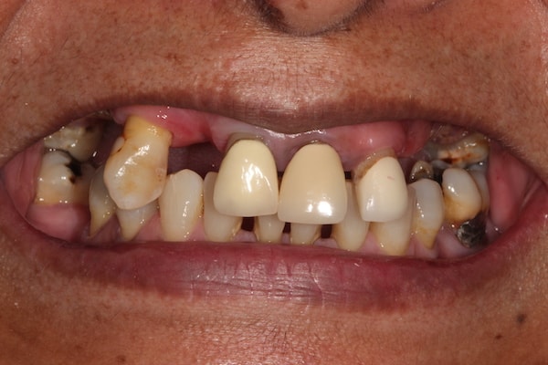 Before and After Invisalign Treatment Kingston