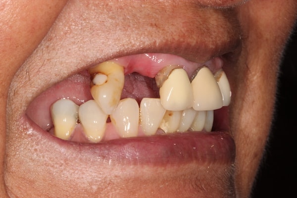 Before and After Invisalign Treatment Kingston