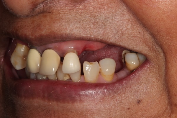 Before and After Invisalign Treatment Kingston