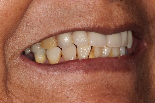 Before and After Invisalign Treatment Kingston