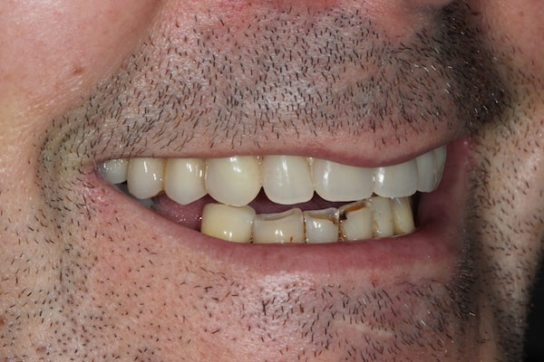 Before and After Invisalign Treatment Kingston