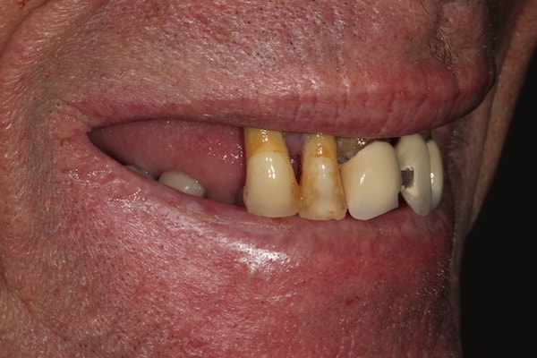 Before and After Invisalign Treatment Kingston