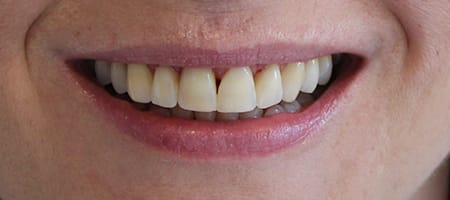 Before and After Invisalign Treatment Kingston Before and After Invisalign Treatment Kingston