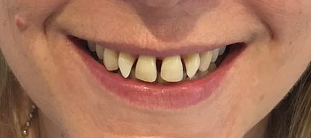 Before and After Invisalign Treatment Kingston Before and After Invisalign Treatment Kingston