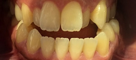 Before and After Invisalign Treatment Kingston Before and After Invisalign Treatment Kingston