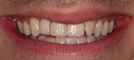 Before and After Invisalign Treatment Kingston