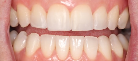 Before and After Invisalign Treatment Kingston Before and After Invisalign Treatment Kingston