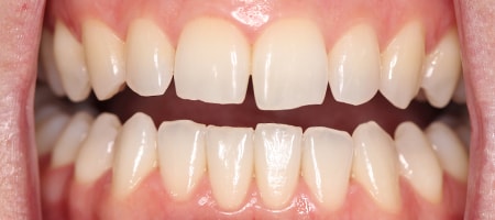 Before and After Invisalign Treatment Kingston Before and After Invisalign Treatment Kingston