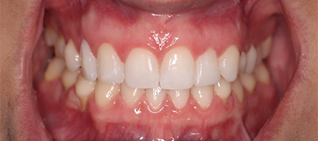 Before and After Invisalign Treatment Kingston Before and After Invisalign Treatment Kingston