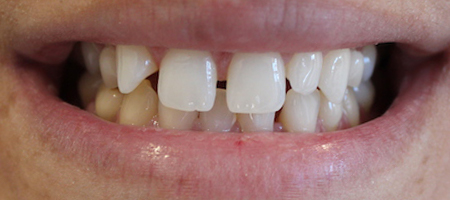Before and After Invisalign Treatment Kingston Before and After Invisalign Treatment Kingston