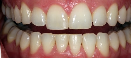 Before and After Invisalign Treatment Kingston Before and After Invisalign Treatment Kingston