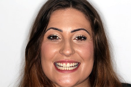 Before and After Invisalign Treatment Kingston Before and After Invisalign Treatment Kingston