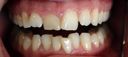 Before and After Invisalign Treatment Kingston Before and After Invisalign Treatment Kingston