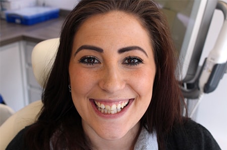 Before and After Invisalign Treatment Kingston Before and After Invisalign Treatment Kingston