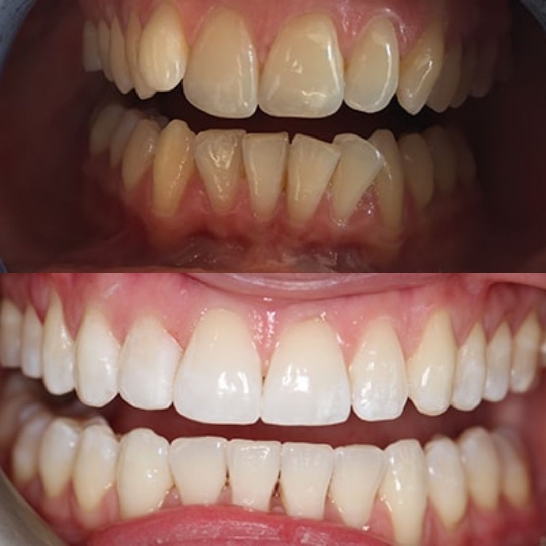 invisalign before after 1