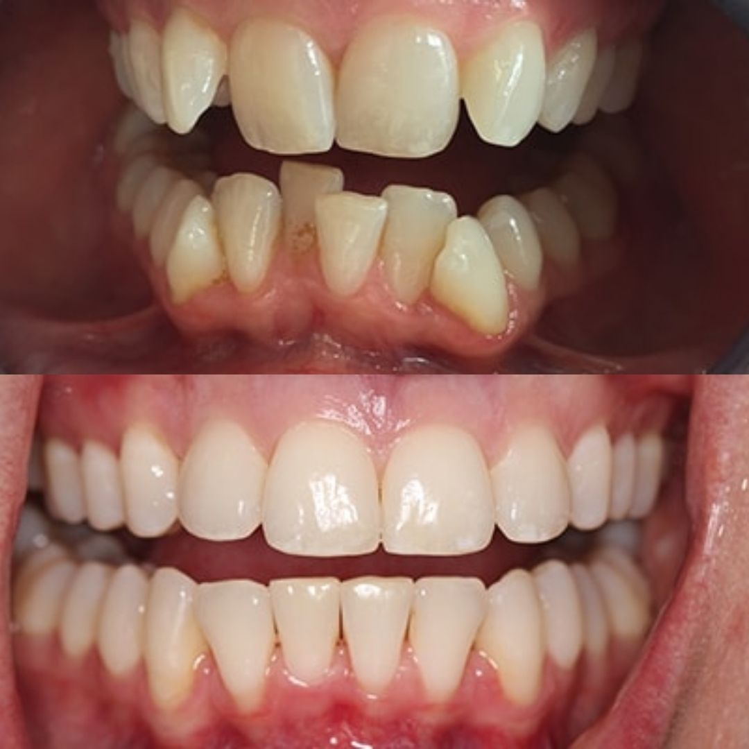 invisalign before after 2